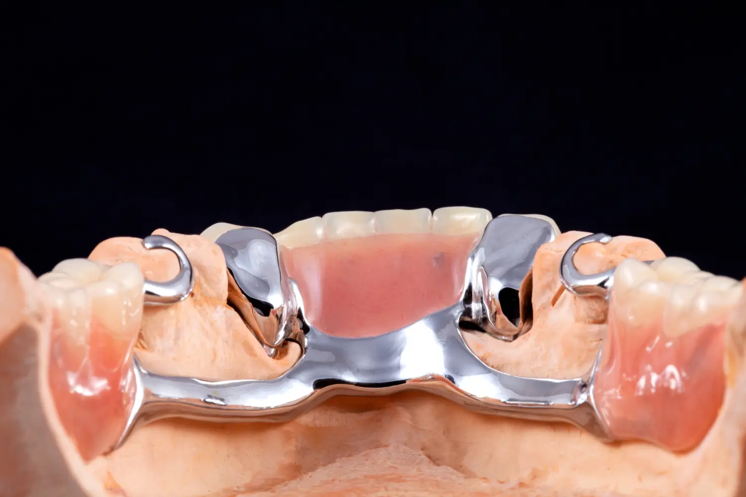 MOG-/Kombiprothesen von T.K.dent Dentallabor GmbH